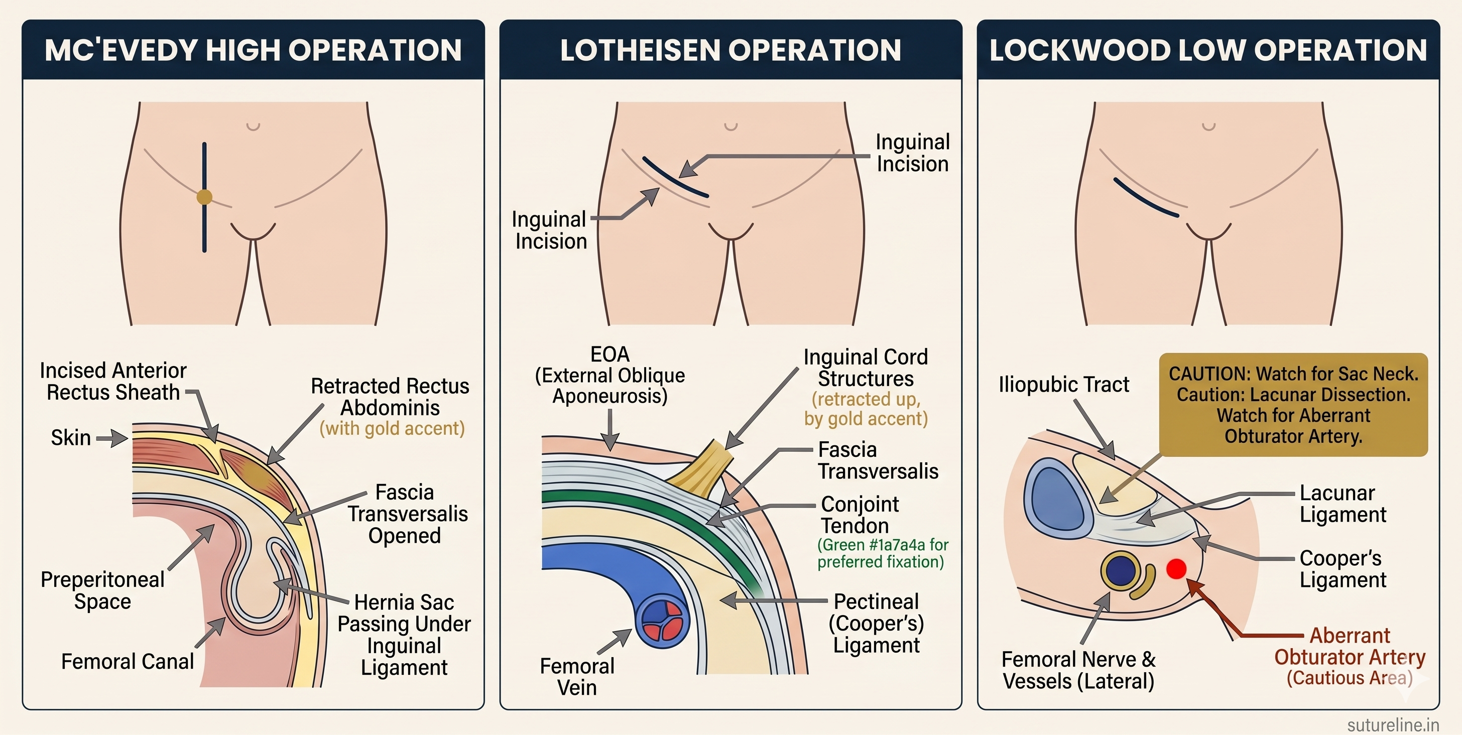 Femoral hernia repair operations