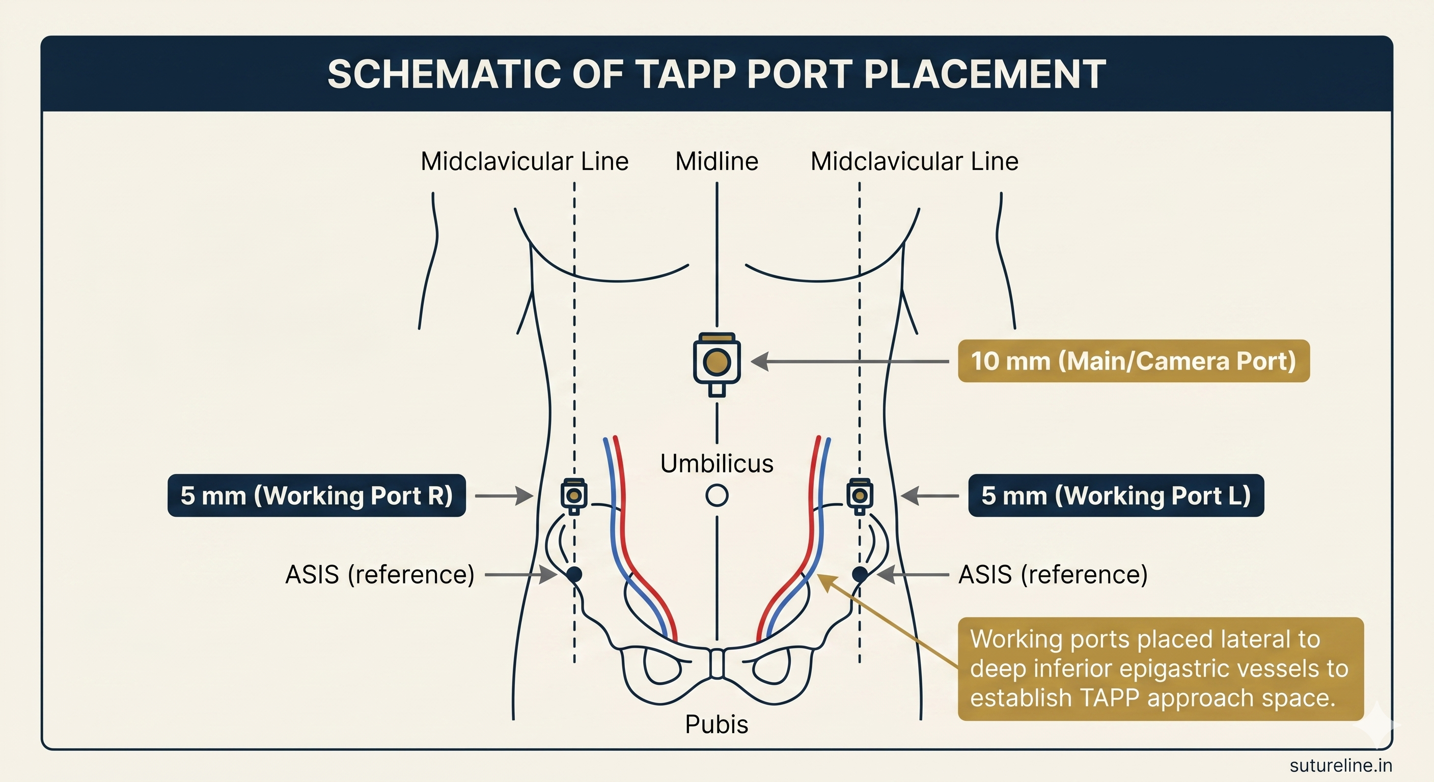 TAPP port placement schematic