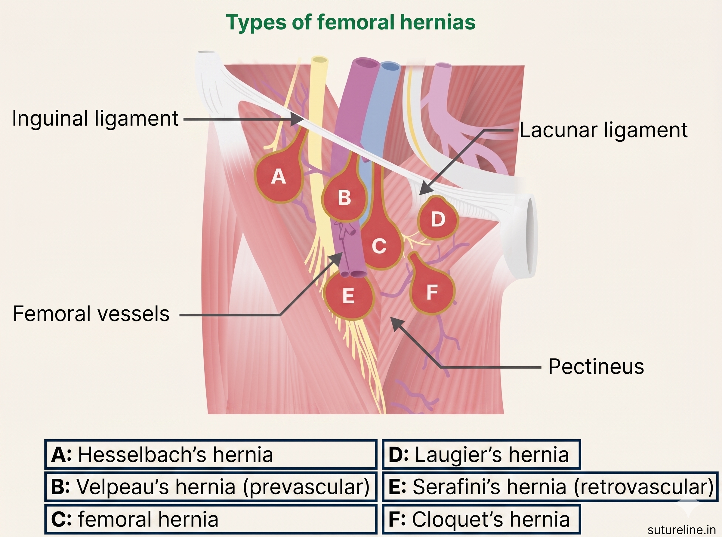 Types of femoral hernias A-F